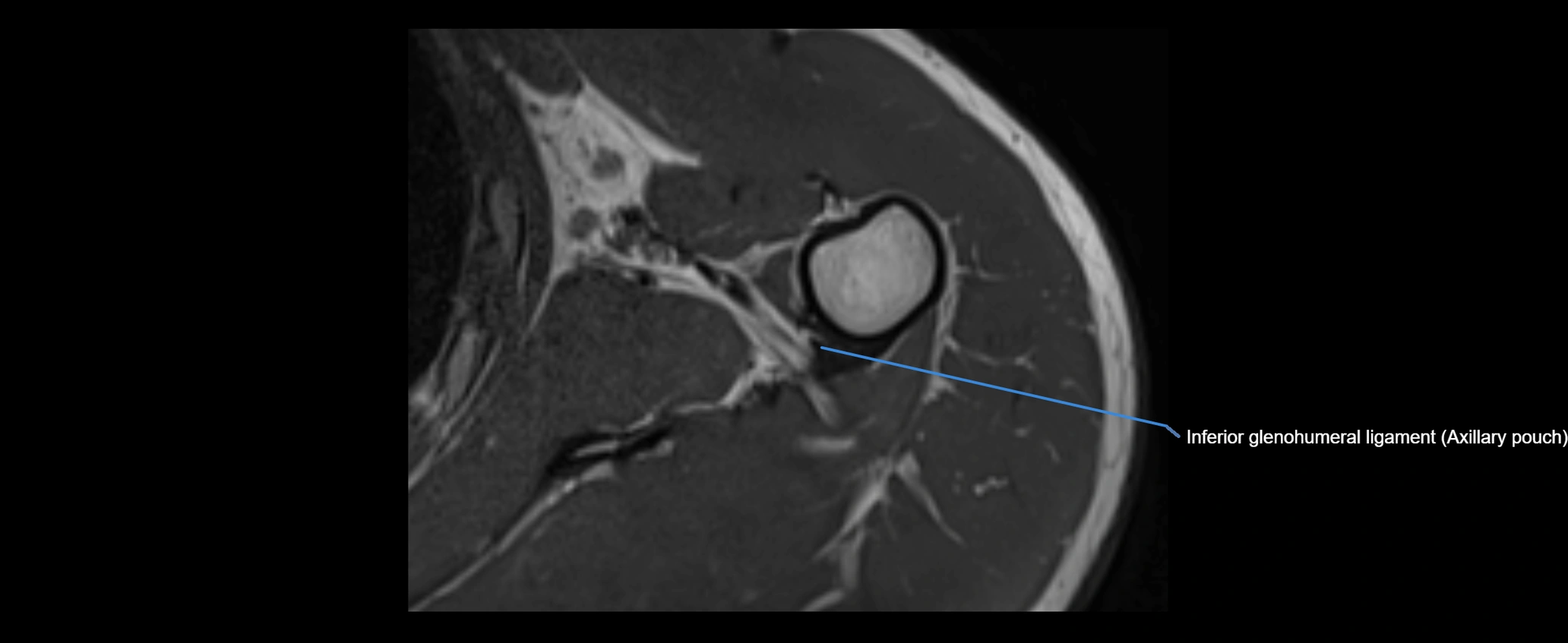 shoulder ligaments axial 3d 3t mri image-img-00005-00095.webp